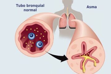 Neumólogo de Mayo Clinic Healthcare ofrece sugerencias para controlar el asma