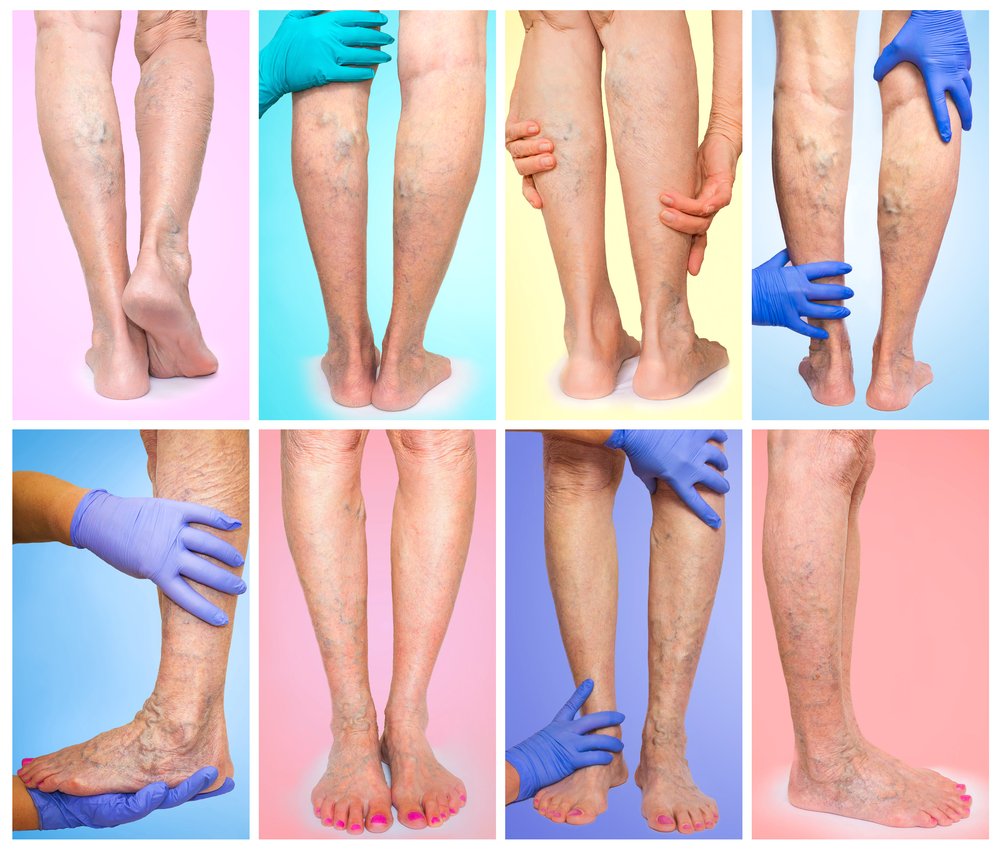 ¿Pueden las venas varicosas causar dolor en la pierna?