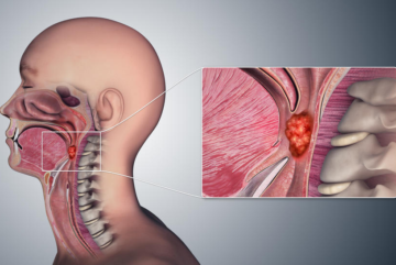 La infección por el VPH puede causar cáncer de boca y de garganta