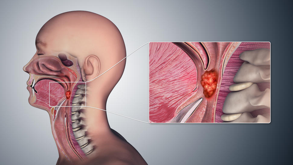 La infección por el VPH puede causar cáncer de boca y de garganta