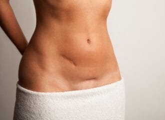 Apendicectomía: la cirugía más frecuente en el abdomen